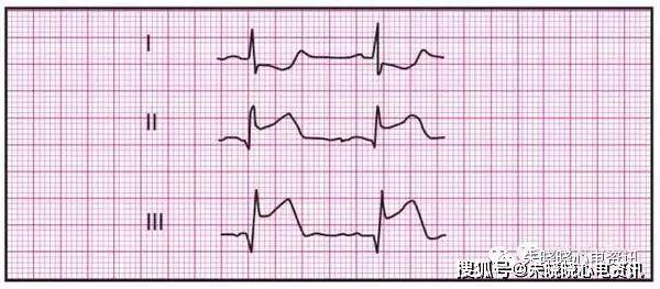 最全异常心电参考图