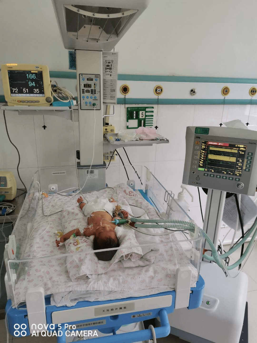 喜报我院再次应用高频呼吸机成功抢救危重早产儿