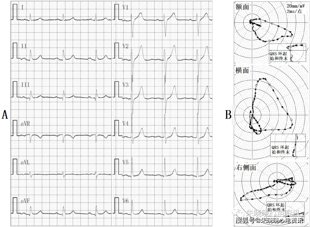 罗昭林老师:心电向量图对心电图上不典型心肌梗死q波的鉴别作用