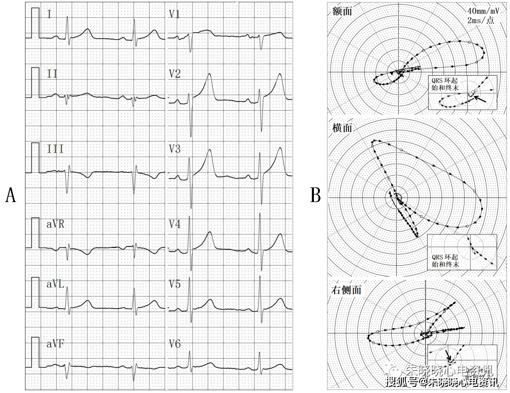 图15 Ⅱ,Ⅲ,avf的qrs波群起始呈线性r波的陈旧性下壁mi