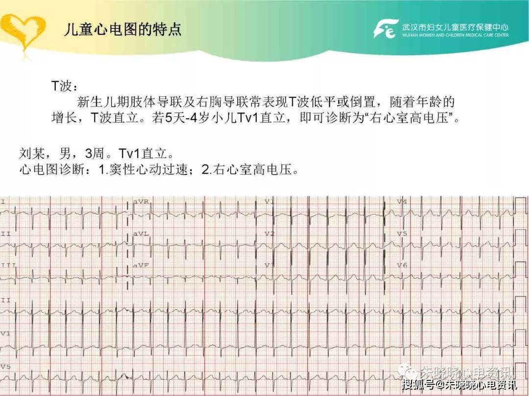 儿童心电图