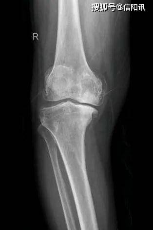 膝关节置换医院排名_膝关节置换图片