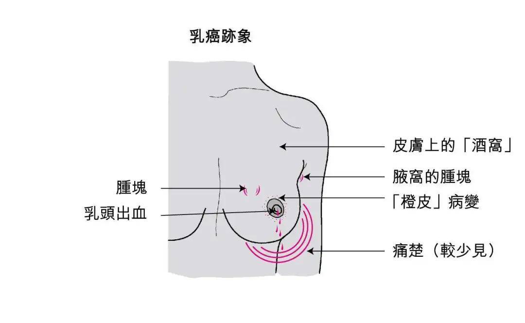 女性健康的"第一杀手"乳腺癌,你会自查吗?