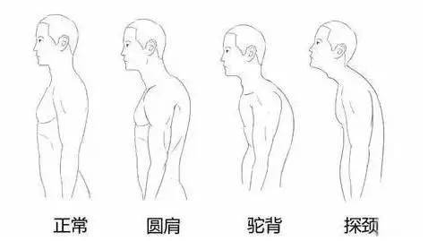 家长总提醒你把背挺直了难看的头前伸该怎么纠正