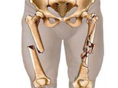 关于大腿骨骨折康复训练要点及注意事项