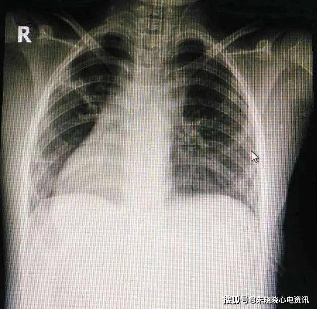 镜像右位心的 f 导联心电图特征读析_心脏