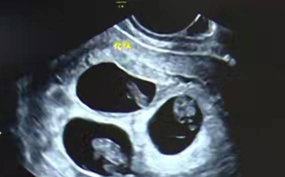 39岁二胎妈妈试管怀三胞胎，分别孕20周26周30周生出，医生：罕见