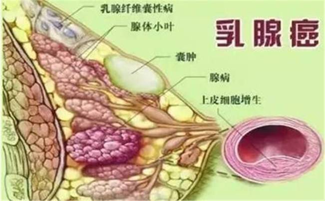 乳腺癌早期的体征与常见表现