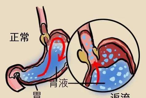 科普:慢性咽炎的病因,种类及治疗!看这篇就够了,建议收藏