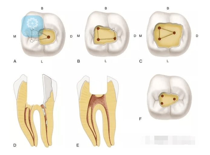 学会这八种方法,临床上寻找根管口变得超简单
