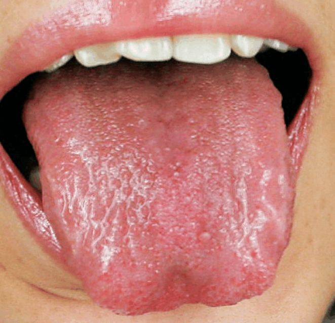 阴虚体质的人舌象是什么样子?