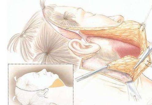 拉皮手术恢复要多久 fe5003ff68c144b68f21dbeec6bd289a.jpeg