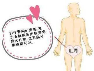 尖锐湿疣医院排名