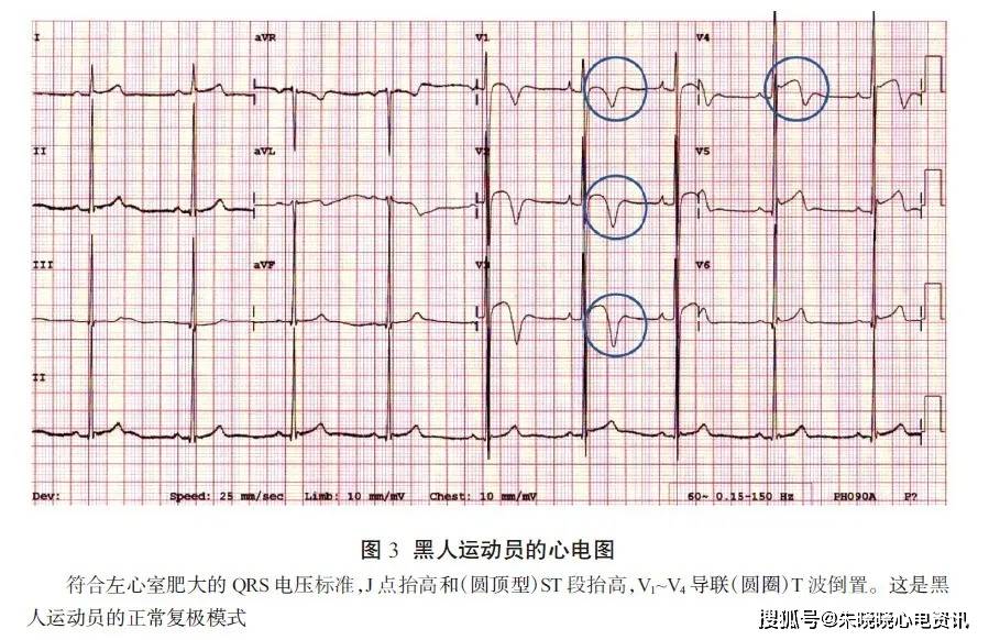 超过三分之二的黑人运动员心电图有复极改变[29, 30, 42, 43]