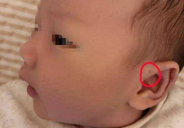 孩子|但父母心里要有数为啥新生儿的耳朵有“小孔”？医生一般不会讲