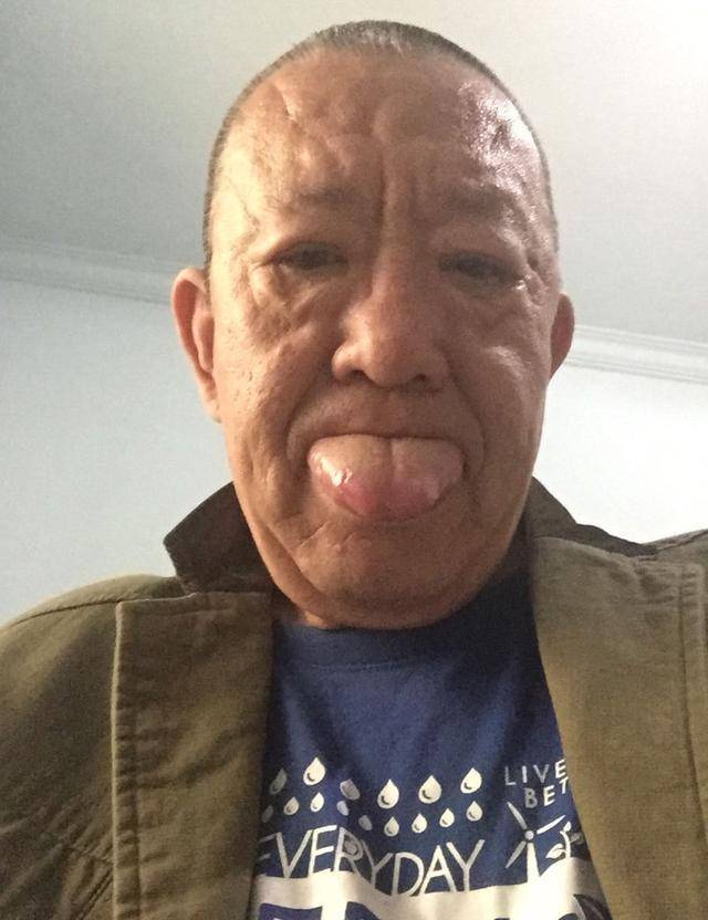 吃饭不小心咬到舌头,结果竟导致了舌癌!