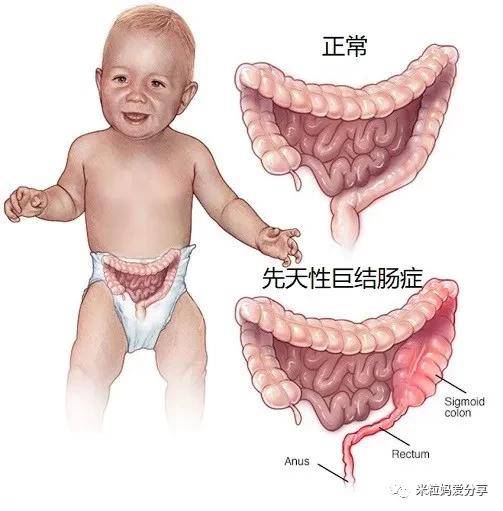 孩子|很可能是缺油！宝宝便秘不一定是缺水
