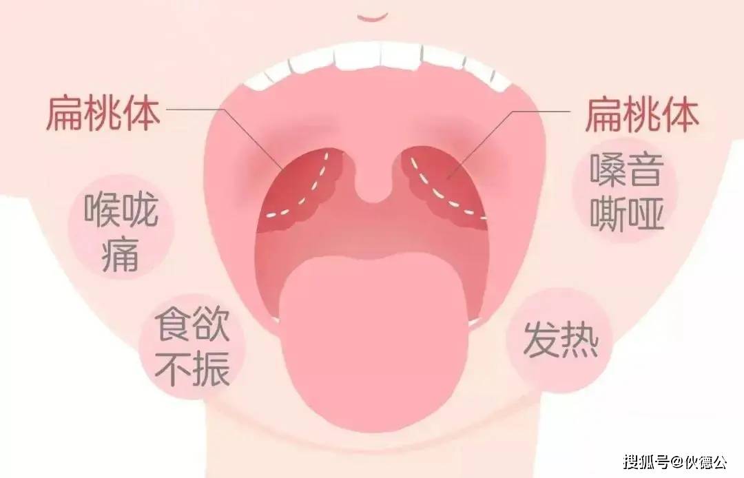 嗓子发炎肿痛怎么办（嗓子发炎肿痛怎么办吃什么消炎药）-85模板网