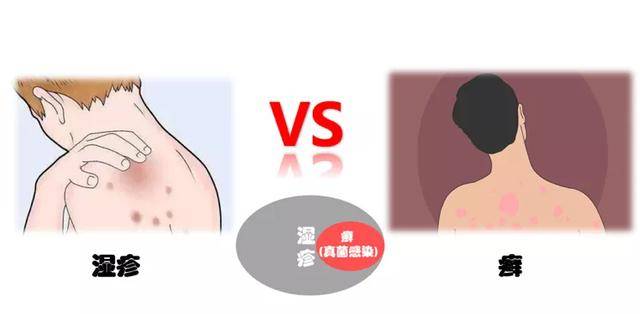 湿疹还是癣,用药怎么选?
