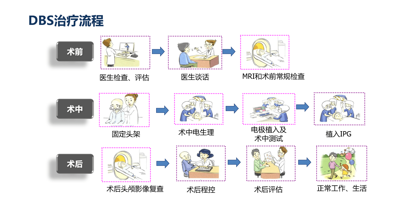 帕金森病为什么会便秘帕金森便秘如何治疗dbs治疗帕金森便秘