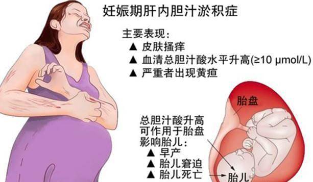 怀孕后期妊娠纹怎么办