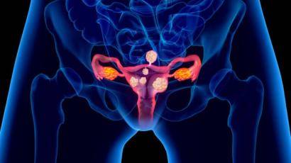 原创患上子宫肌瘤,身体会出现哪些异常作为警告.
