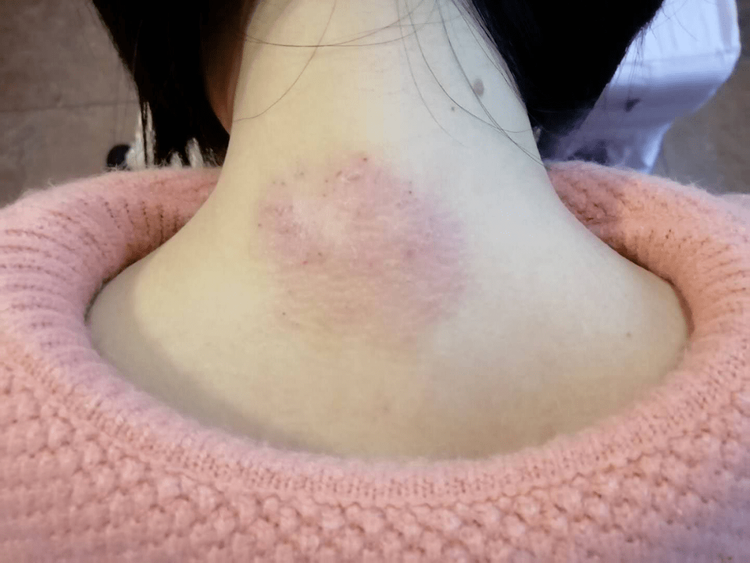原创同胞姐妹同患神经性皮炎,治疗是一样的吗?
