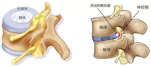 腰间盘突出微创手术是什么原理_腰间盘突出微创手术图(3)