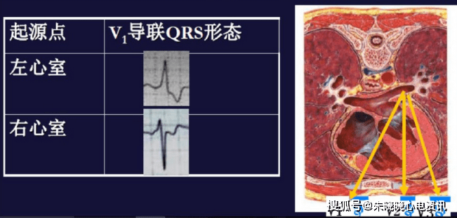 若qrs波正向,可能起源于心室流出道附近;若qrs波负向,可能起源于心室