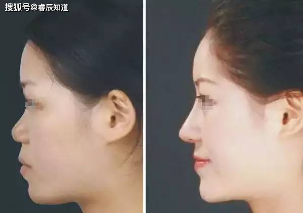 塌鼻梁的人能不能面中挺拔 b053fcb37fd5482498359fc807d07592.jpeg