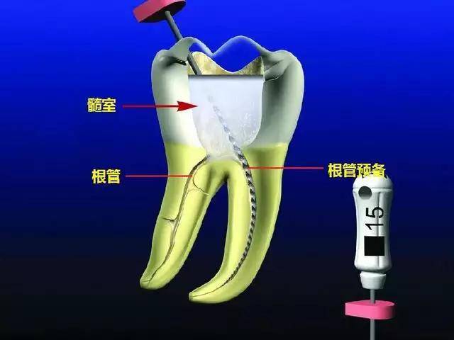 事实上,根管治疗术是通过牙医通过专用的器械通过彻底去除牙齿内部
