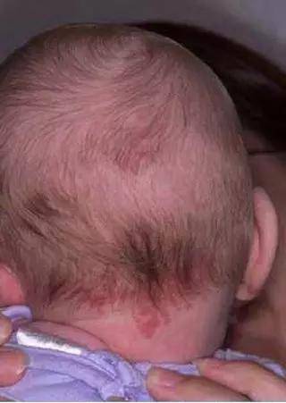 孩子各种胎记、血管瘤、斑、痣全面分析！