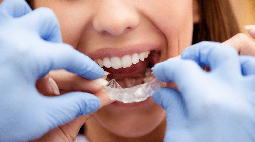 大连齿医生口腔科普 关于隐形牙齿矫正,没有误解就没有犹豫!
