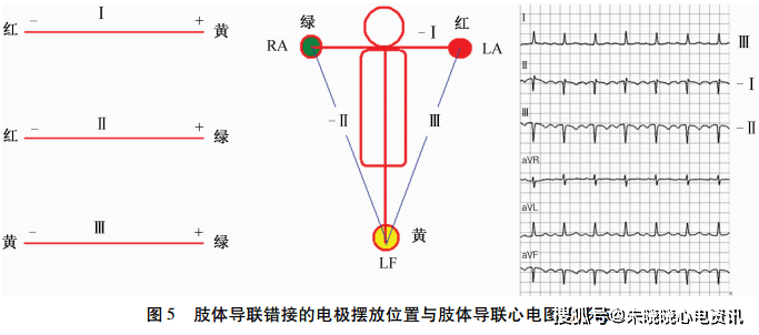 图解肢体导联电极错接的心电图表现