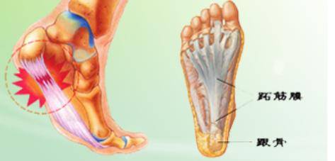 简单来说 足底筋膜炎就是足底肌肉筋膜产生无菌性炎症,引发足底疼痛.