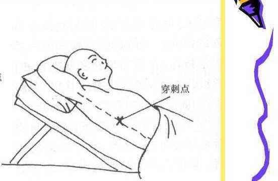 传统治疗恶性胸腔积液分为全身治疗和局部治疗,局部治疗包括胸腔穿刺
