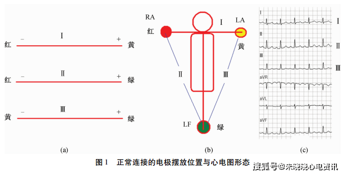 第1通道"i"由红色电极(-)和黄色电极( )组成,第2通道"ii"由红色电极