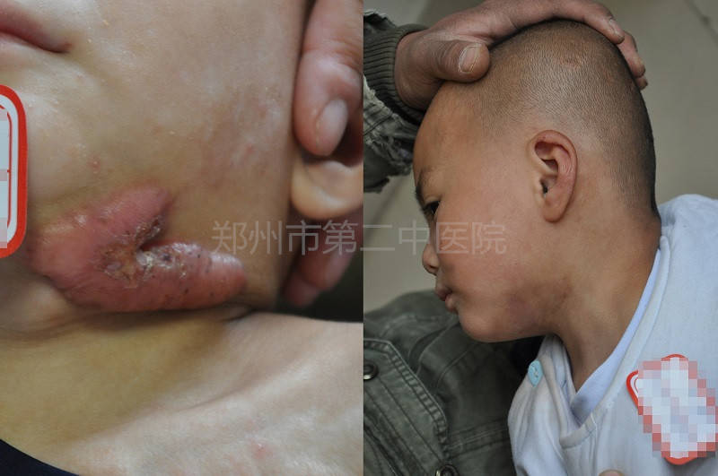 郑州市第二中医院破:增生疤痕三个阶段?