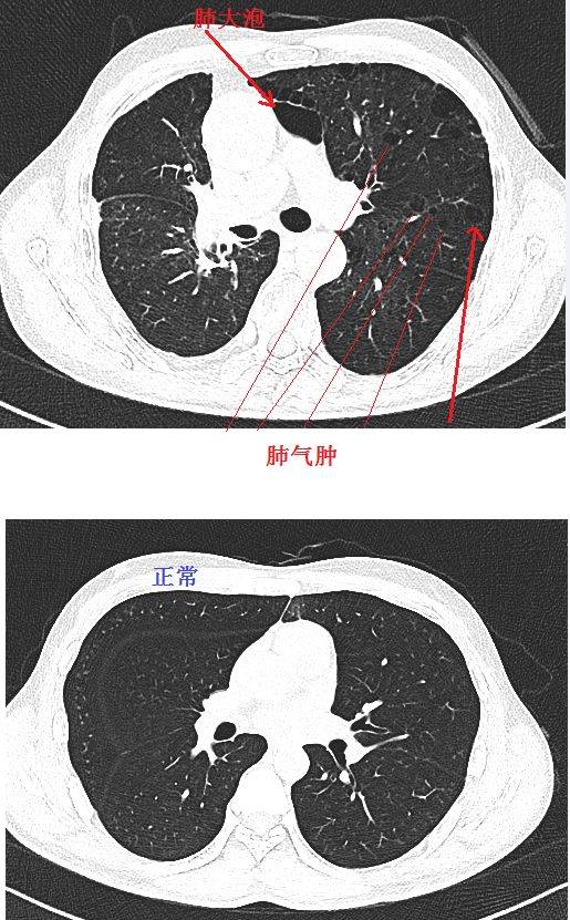 经典图谱 实战图谱,一文看懂肺气肿!