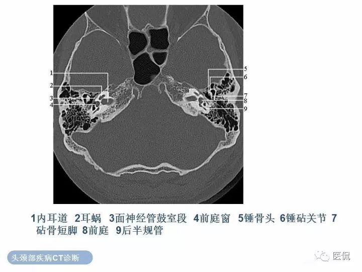 挑灯难找的影像经典最全颞骨详细ct解剖