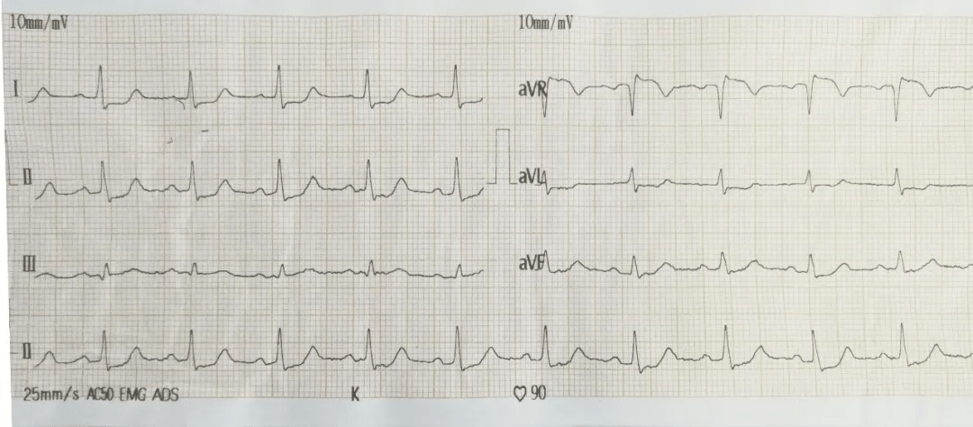 图1急查心电图(ecg)显示avr导联st段弓背向上抬高,其余导联st段均显著