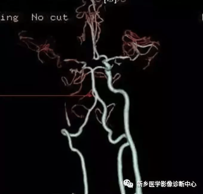 20,椎基底动脉延长扩张