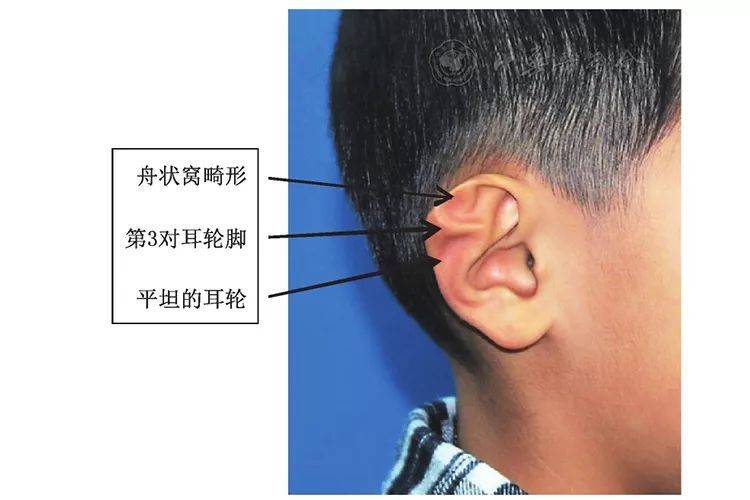 杯状耳?一招让你辨别8种外