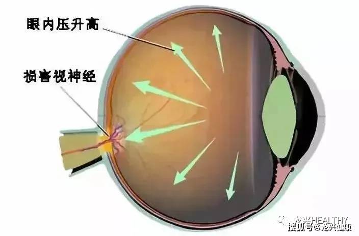 这是由于近视眼眼房角处滤帘结构不正常,所以眼内的房水流出阻力较大