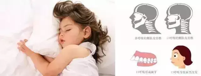 牙齿|家长请注意：孩子12岁前必须矫治的几种牙齿畸形