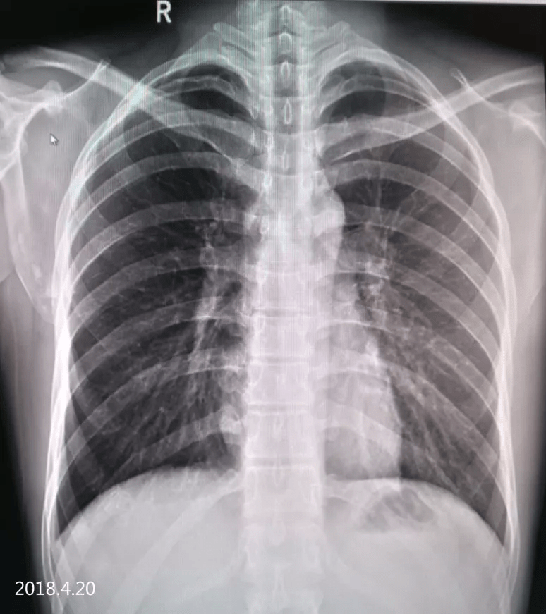 气胸的x线表现6个病例帮你搞定