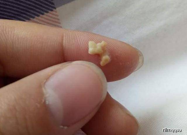 医院|到医院检查后，取出的东西令人反胃被嫌弃口臭的儿子不愿上学