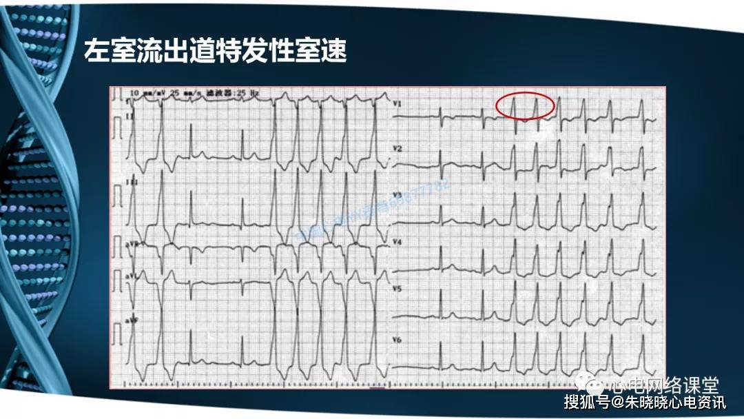 杨明老师:室性心动过速的识别与治疗