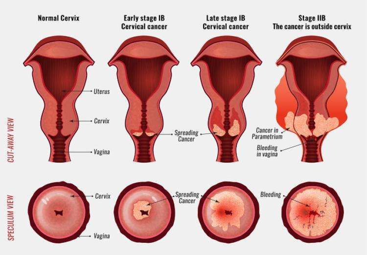 有效侦测受检者宫颈细胞是否属于正常,或者属于癌前病变lsil,hs