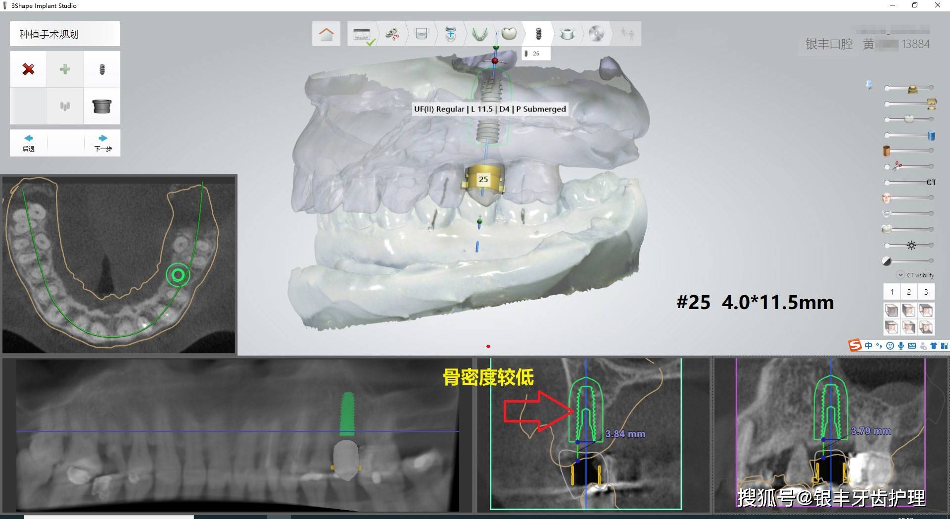 因为我们现在选用数字化导板种植技术 整合患者的ct和牙模数据 植入